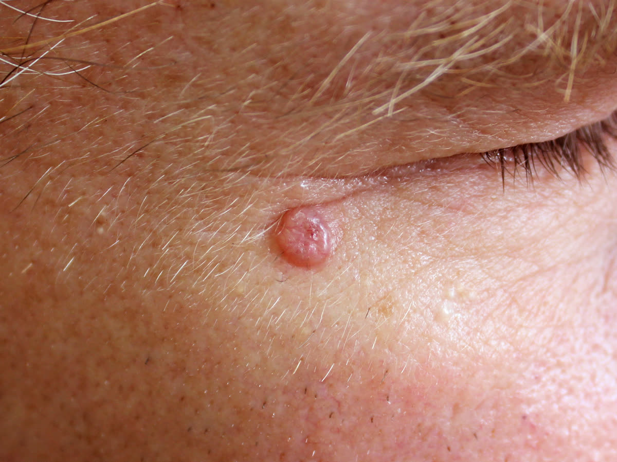 Basal cell carcinoma — pearly pink bump with visible vessels