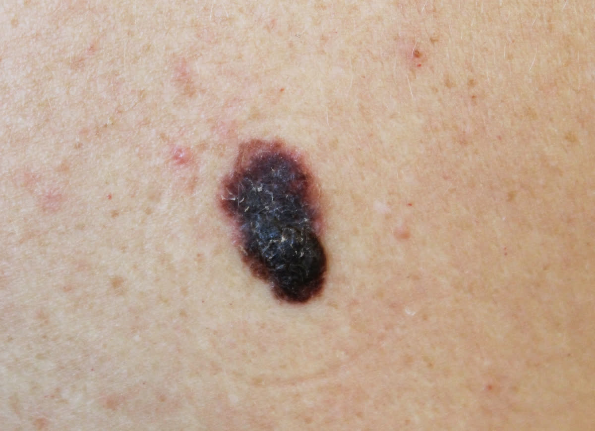 Melanoma — dark, asymmetric mole with irregular border