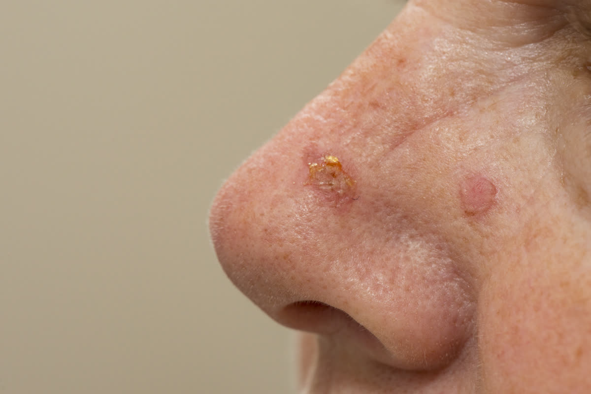 Squamous cell carcinoma — rough, crusted red patch