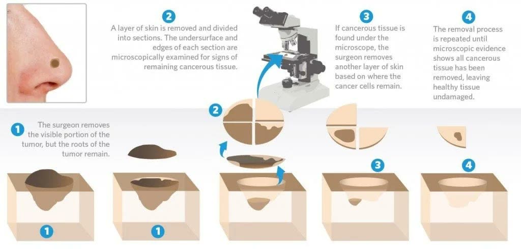 Diagram of the Mohs surgery process: the visible tumor is removed, each layer is divided and examined under the microscope, and removal repeats only where cancer cells remain until margins are clear