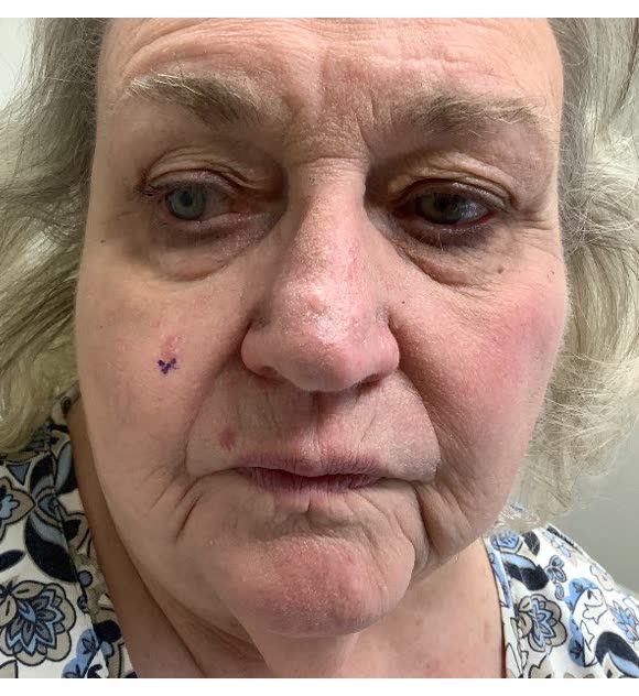 Before Mohs surgery: basal cell carcinoma on the right cheek