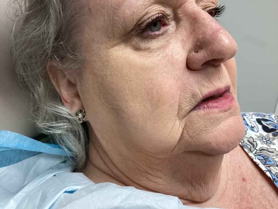 Healed after Mohs surgery, 6 months later: basal cell carcinoma on the right cheek