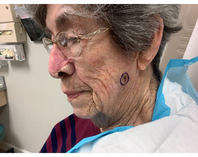 Before Mohs surgery: squamous cell carcinoma on the left cheek