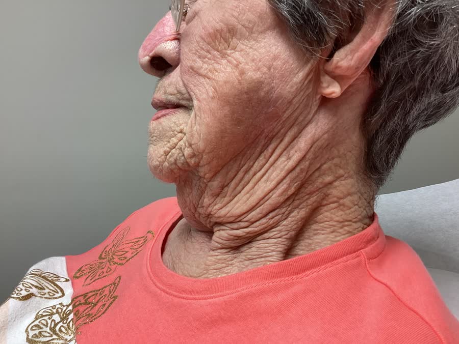 Healed after Mohs surgery, 1 year later: squamous cell carcinoma on the left cheek