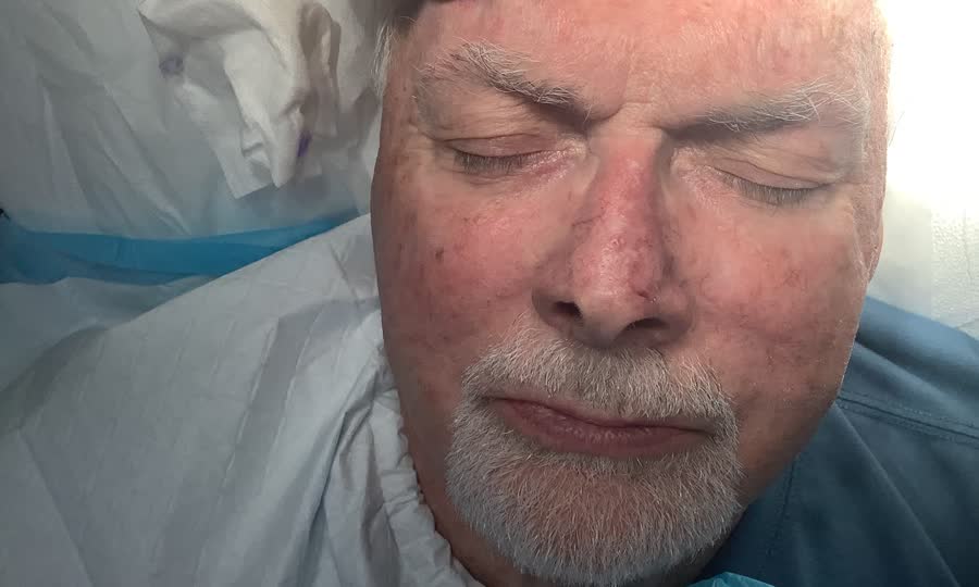 Mohs case 5 — Healed: basal cell carcinoma on the nasal supratip
