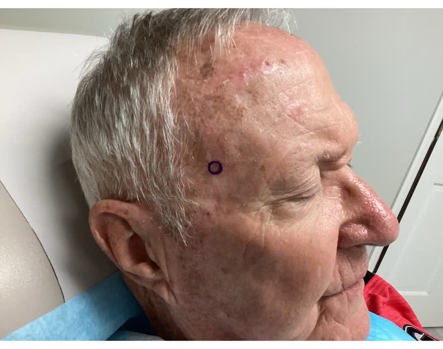 Before Mohs surgery: squamous cell carcinoma on the right forehead