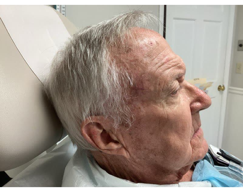 Healed after Mohs surgery, 4 weeks later: squamous cell carcinoma on the right forehead