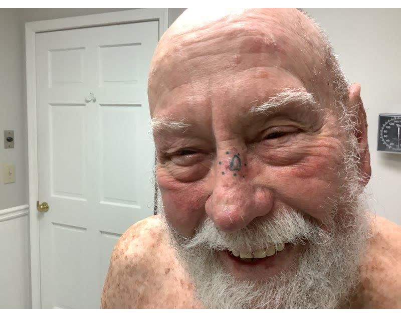 Mohs case 7 — Before: squamous cell carcinoma on the nose