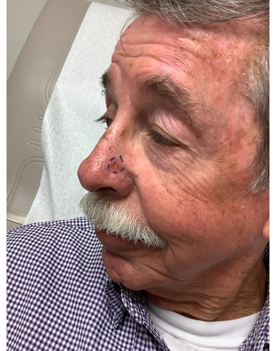 Mohs case 11 — Before: infiltrative basal cell carcinoma on the nose