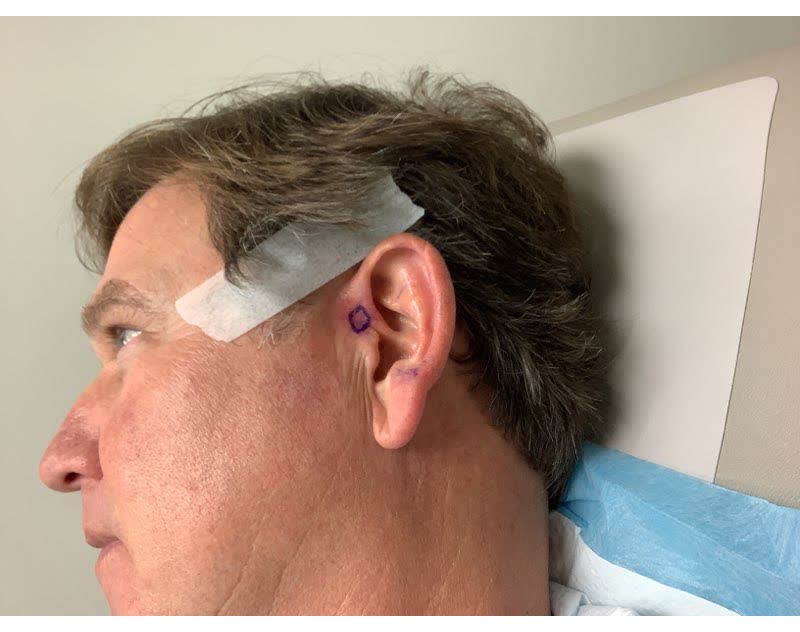 Mohs case 16 — Before: basal cell carcinoma on the left ear and sideburn