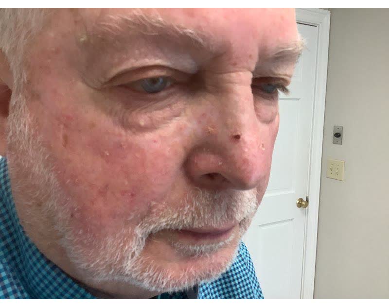 Mohs case 17 — Before: infiltrative basal cell carcinoma on the nose