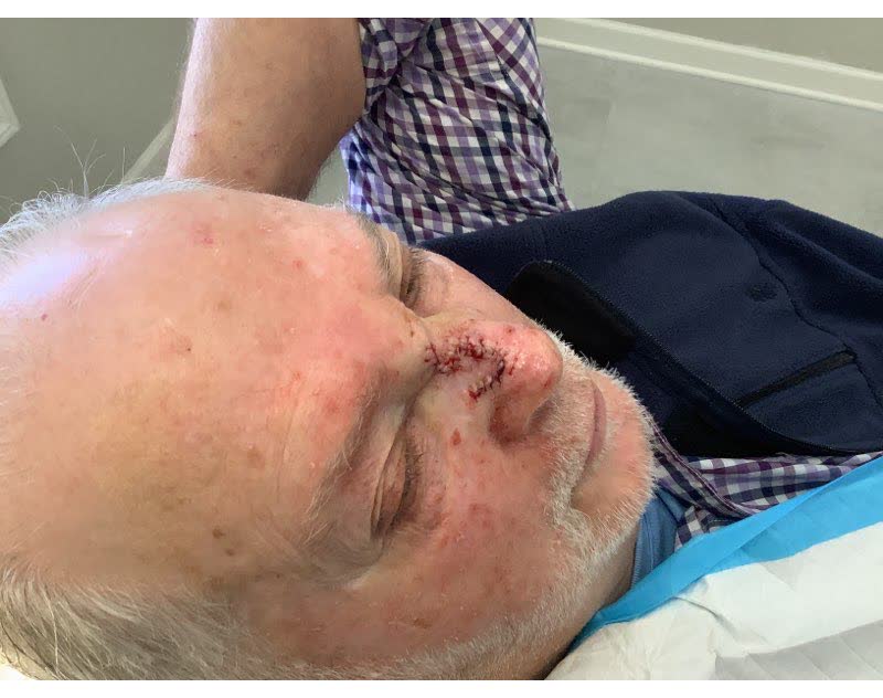Mohs case 17 — Repair · same day: infiltrative basal cell carcinoma on the nose
