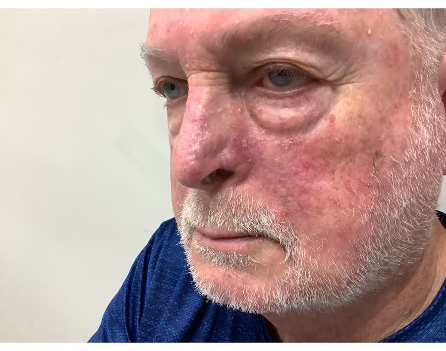 Mohs case 18 — Healed: two basal cell carcinomas on the nose, including the alar rim
